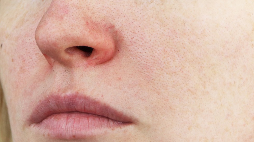 facial-redness-veins-victorian-dermal-group